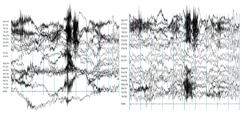 eeg data